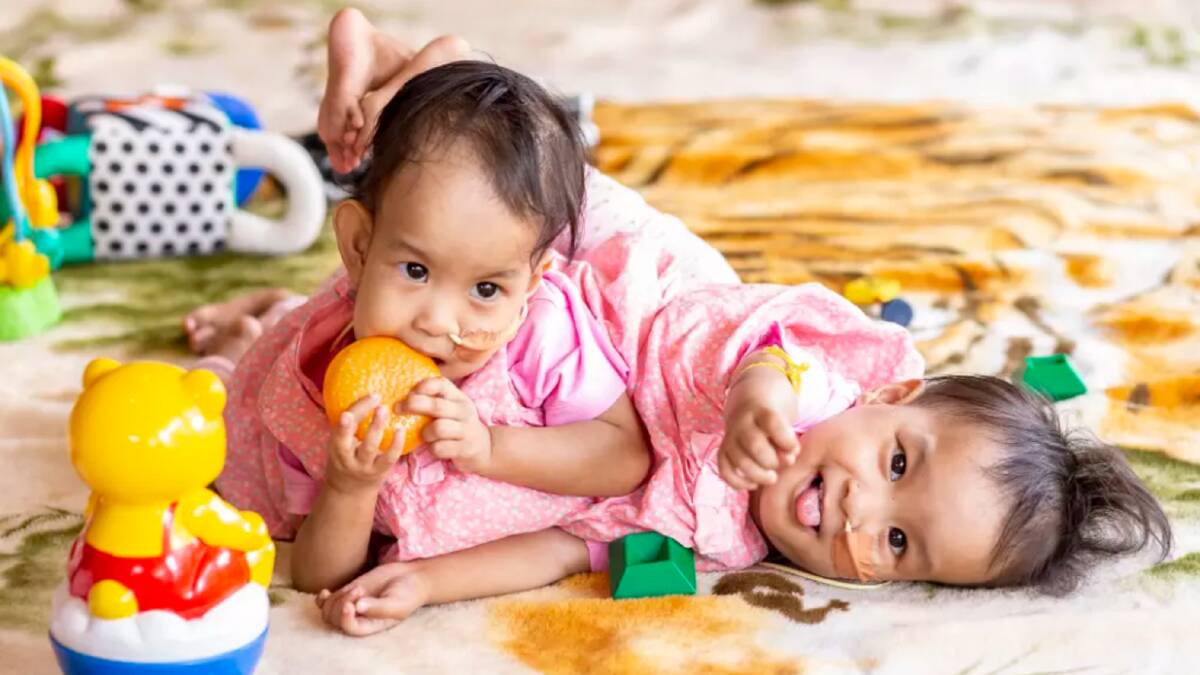 Conjoined twins Nima and Dawa before their surgery. Photo: AAP