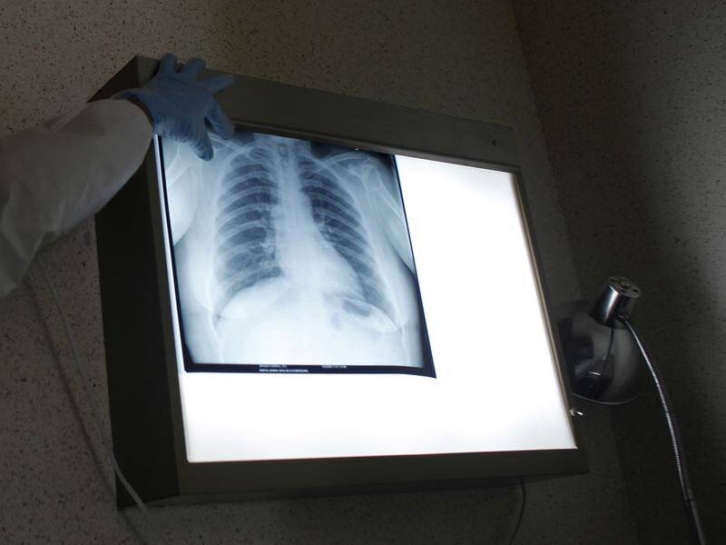 New X-ray technology developed in Victoria will be a boon to diagnosing and treating lung diseases.