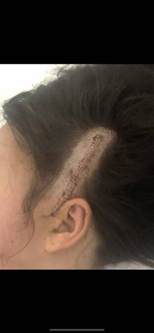 The scar after the tumour was removed. 