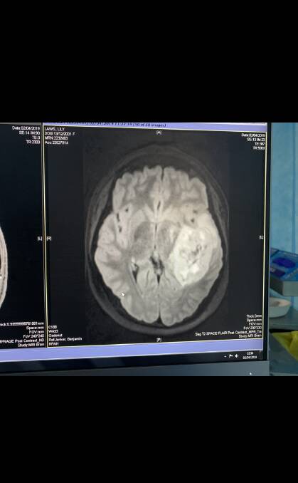 A scan of Lily's brain shows the tumour on the right hand side of the screen. 